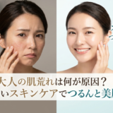 大人の肌荒れは何が原因？正しいスキンケアでつるんと美肌へ